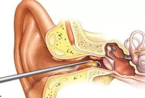 挖耳屎视频,趣味视频带你探索耳道清洁的奥秘